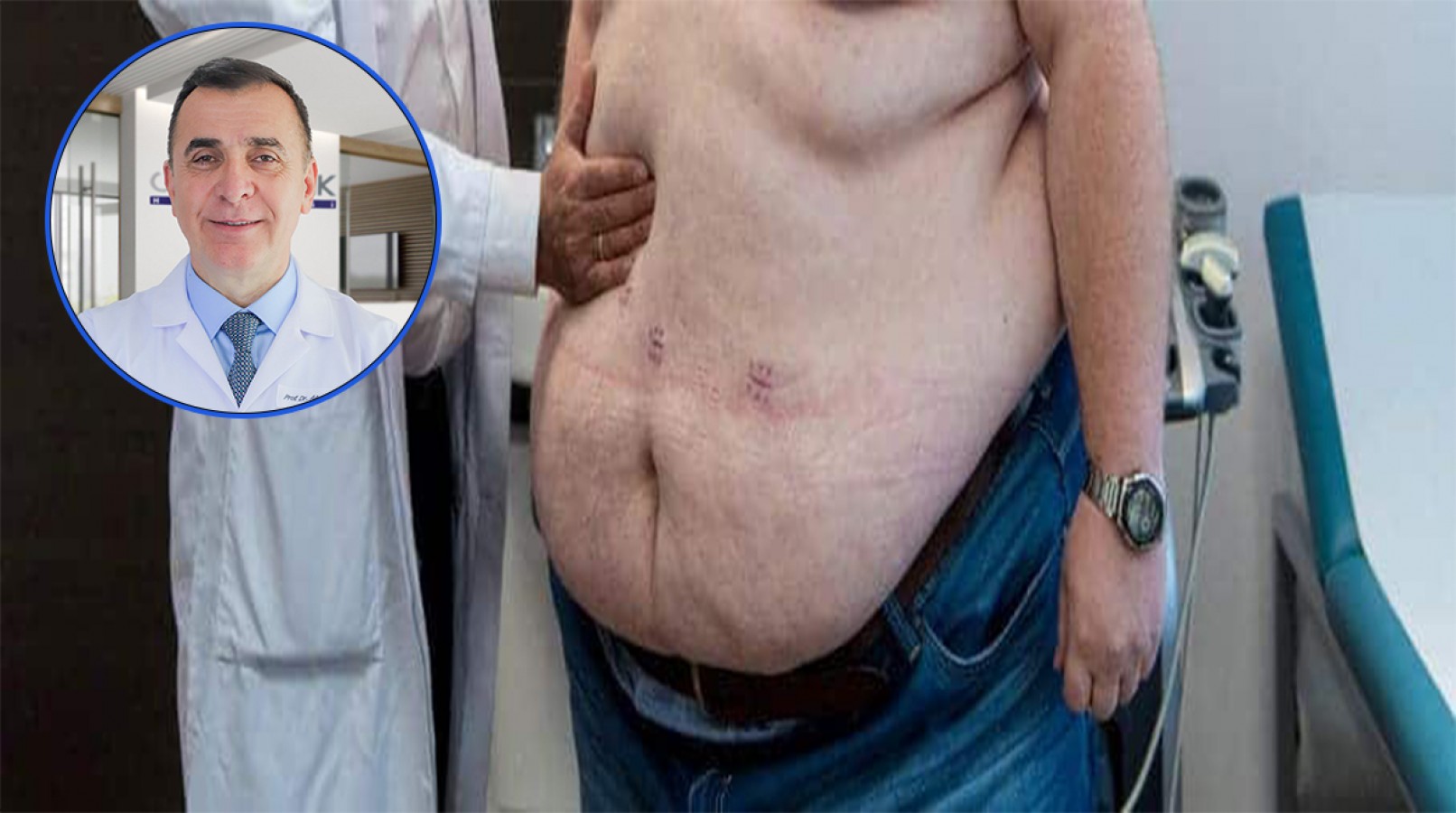 Obezitenin cerrahi tedavisinde ameliyat yöntemi;