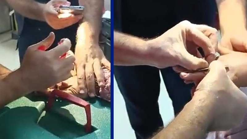 Parmağa sıkışan yüzüğü hastanede doktor çıkardı;